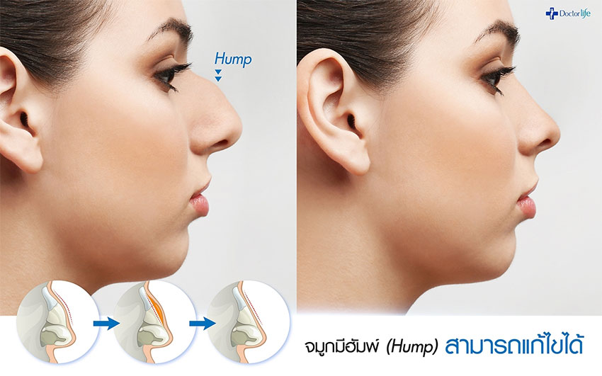 ศัลยกรรมเสริมจมูก