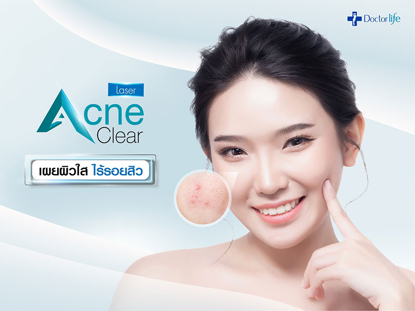 Acne Clear Laser เผยผิวใส ไร้รอยสิว