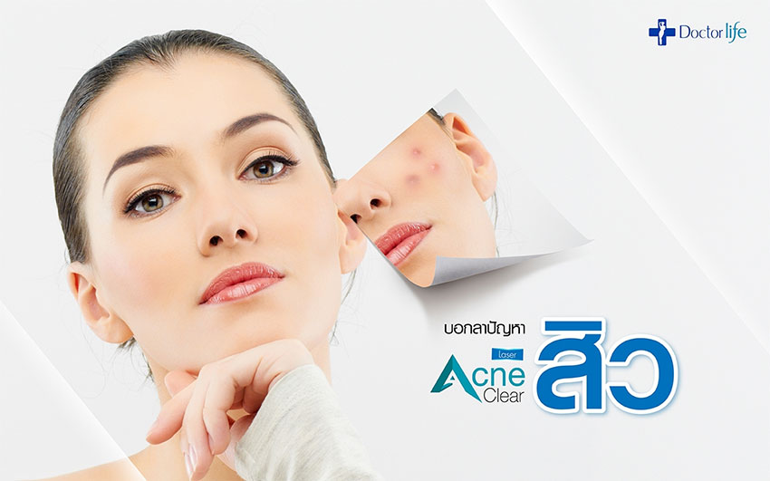 บอกลาปัญหาสิวด้วย Acne Clear Laser