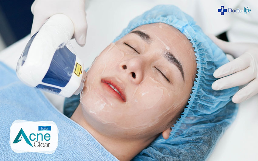 Acne Clear Laser เผยผิวใส ไร้รอยสิว