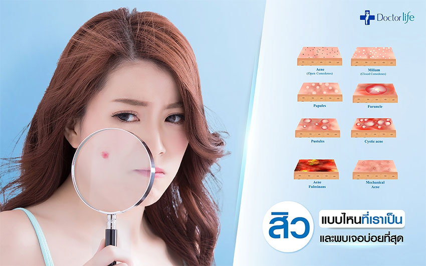 Acne Clear Laser เผยผิวใส ไร้รอยสิว