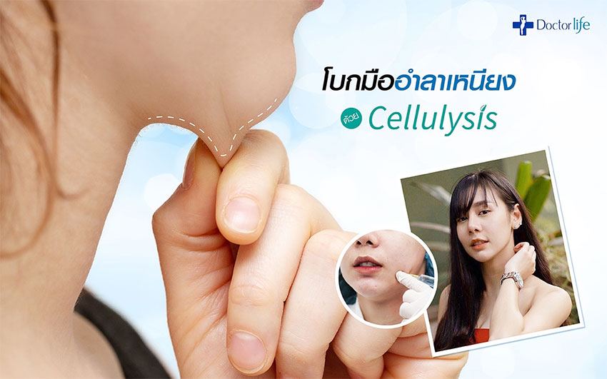 โบกมืออำลาเหนียงด้วย Cellulysis