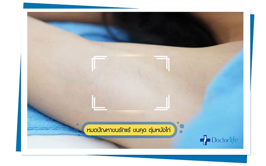 เลเซอร์กำจัดขนถาวร