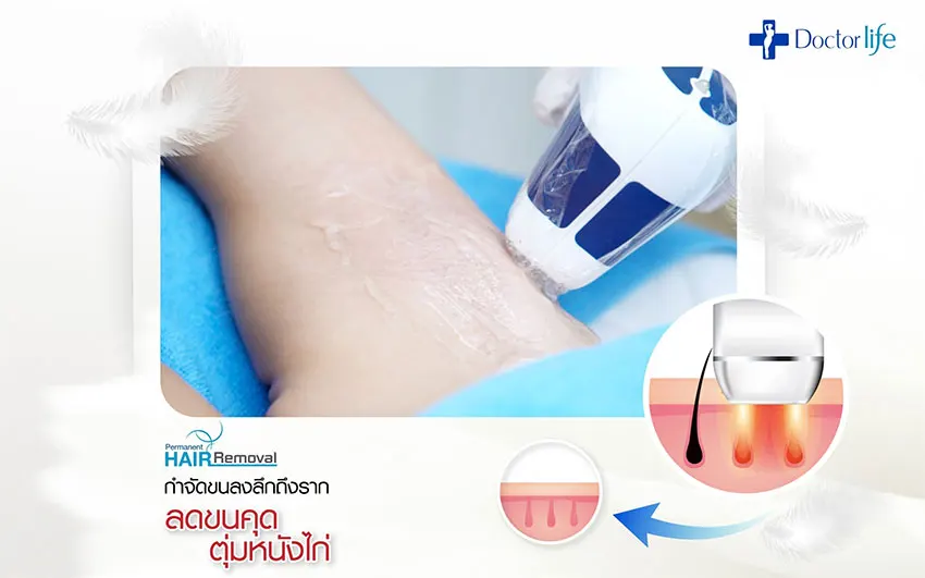 เลเซอร์กำจัดขนถาวร