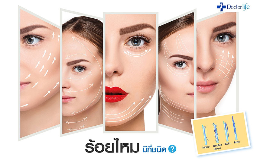 ร้อยไหม Thread Lift