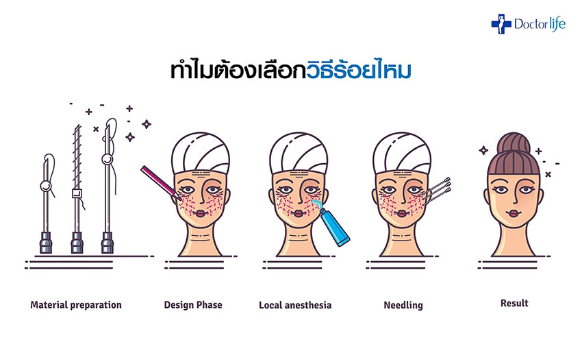 ร้อยไหม Thread Lift