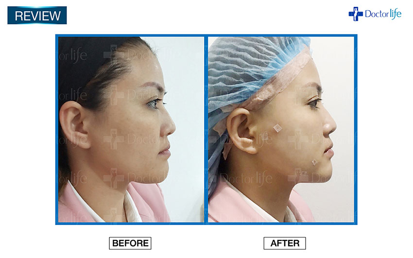 ร้อยไหม Thread Lift