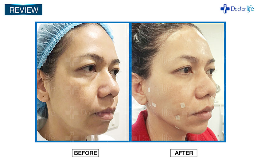 ร้อยไหม Thread Lift