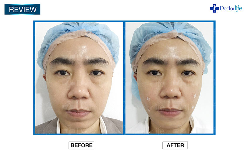 ร้อยไหม Thread Lift