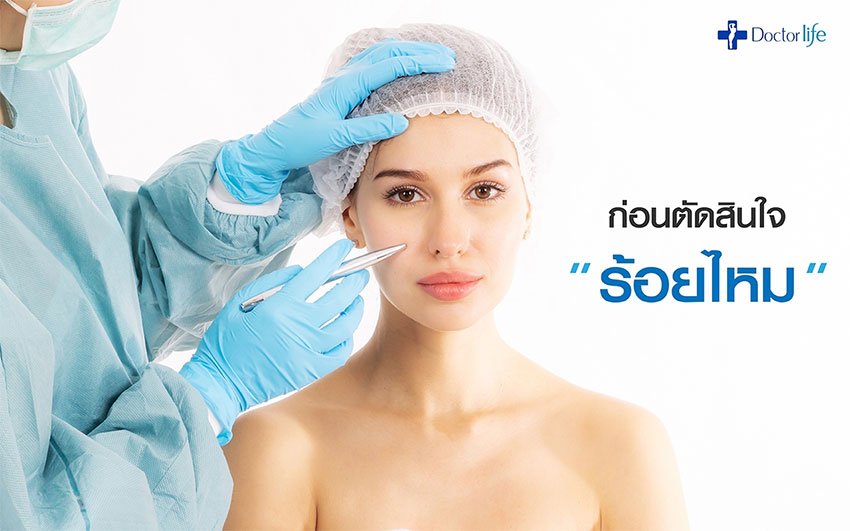 ร้อยไหม Thread Lift
