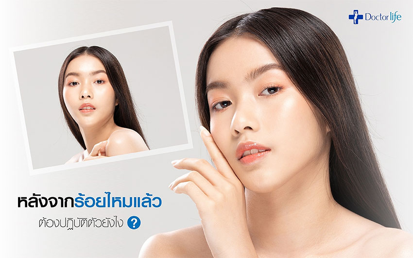 ร้อยไหม Thread Lift