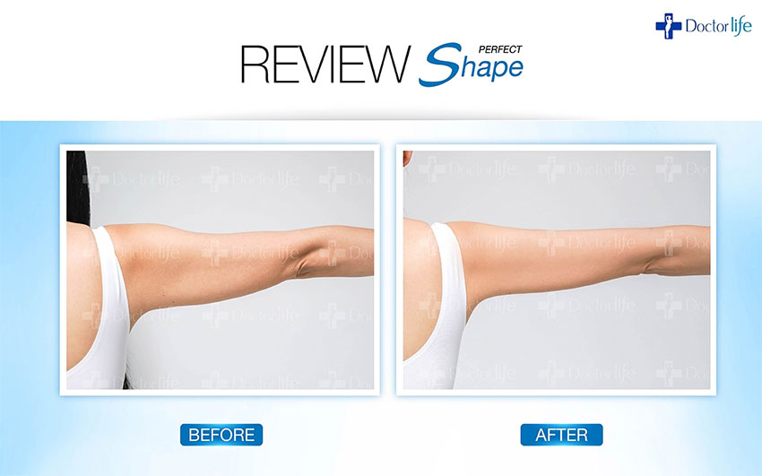 สลายไขมันแบบเร่งด่วน Perfect Shape