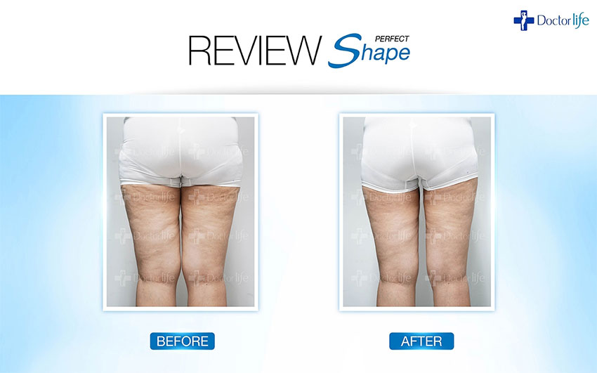 สลายไขมันแบบเร่งด่วน Perfect Shape