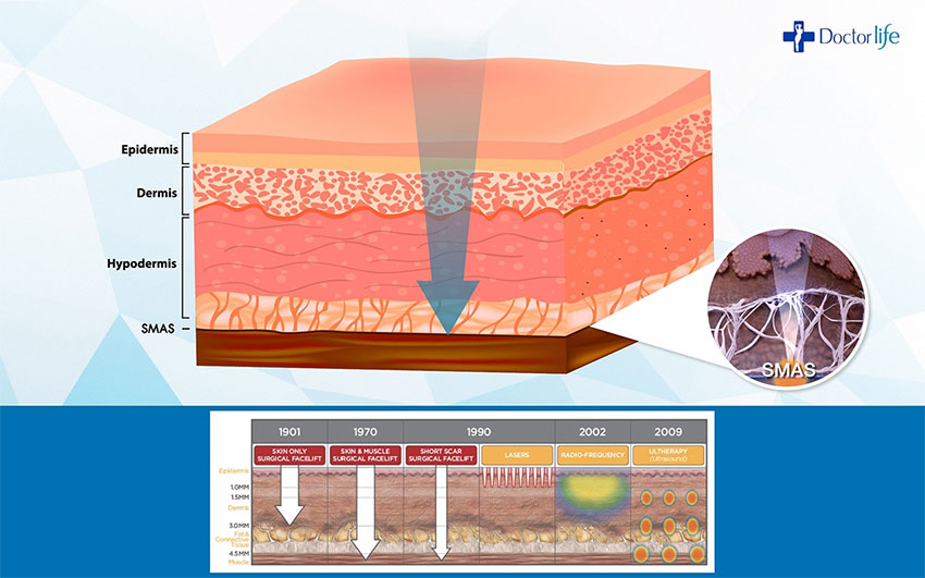 SMAS คืออะไร ยกกระชับผิวได้อย่างไร (ULTHERA)