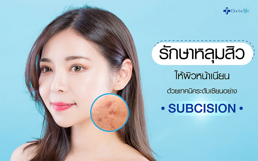 รักษาสิวผิวหน้าเนียน ไม่ว่าจะเป็นสิวอุดตัน สิวอักเสบ หลุมสิว รักษาได้ด้วยเทคนิค Subcision ง่ายๆ
