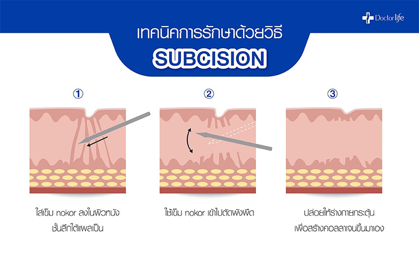 หลุมสิว (subcision) หลุมสิว (subcision)