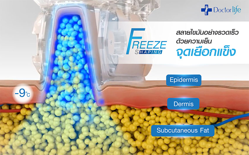 Freeze Shaping สลายไขมันด้วยความเย็น
