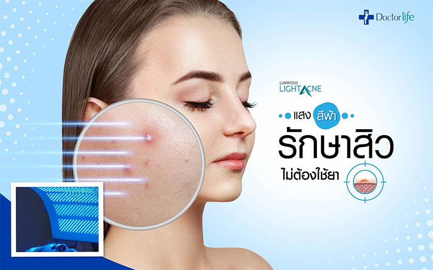Luminous แสงสีฟ้ารักษาสิวฆ่าเชื้อสิวที่เกิดจาก P.acnes