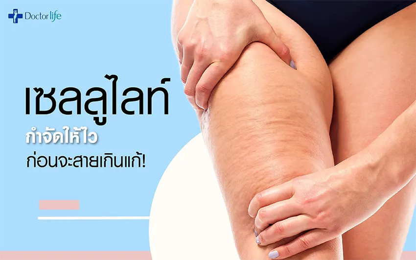 เซลลูไลท์ กำจัดให้ไวก่อนจะสายเกินแก้