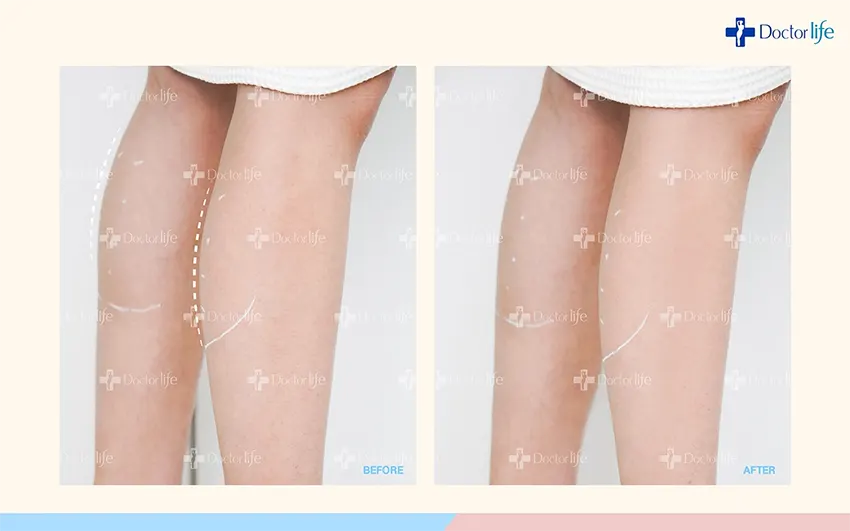 ใส่ส้นสูงบ่อยไม่ใช่ปัญหา โบลดน่องช่วยได้