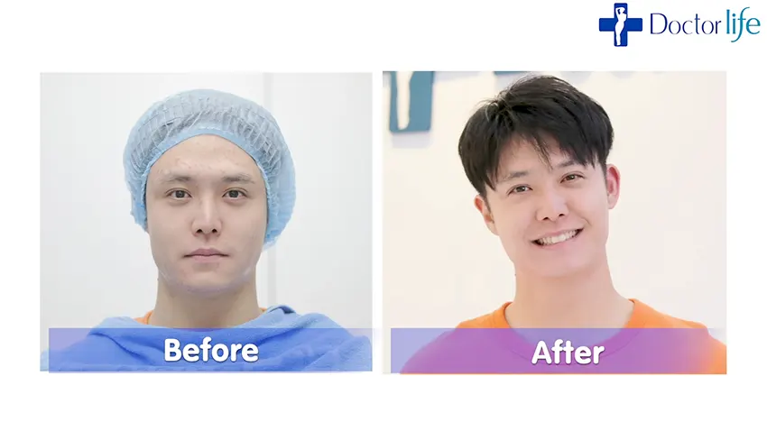 Acne Clear Laser เผยผิวใส ไร้รอยสิว