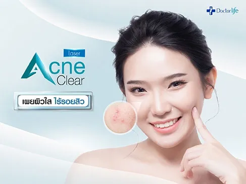 Acne Clear Laser เผยผิวใส ไร้รอยสิว