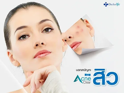 บอกลาปัญหาสิวด้วย Acne Clear Laser