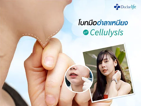 โบกมืออำลาเหนียงด้วย Cellulysis