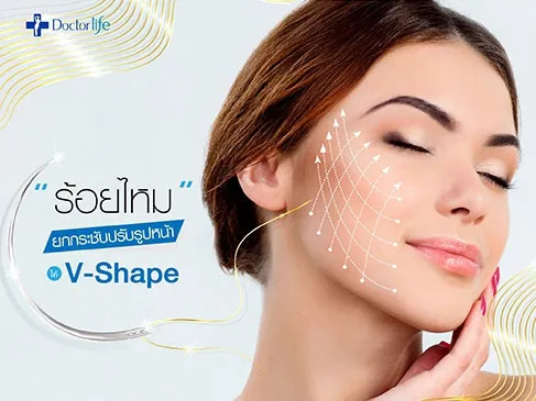 ร้อยไหม ยกกระชับปรับรูปหน้า (Thread Lift)