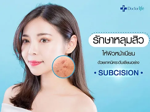 รักษาสิวผิวหน้าเนียน ไม่ว่าจะเป็นสิวอุดตัน สิวอักเสบ หลุมสิว รักษาได้ด้วยเทคนิค Subcision ง่ายๆ