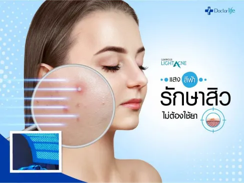 Luminous แสงสีฟ้ารักษาสิวฆ่าเชื้อสิวที่เกิดจาก P.acnes